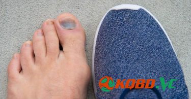 mang giày bị bầm móng chân